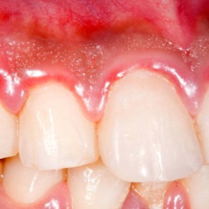 gingivitis