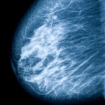 <!--:ES-->La alta densidad en los senos no se asocia con una mayor probabilidad de muerte por cáncer de mama<!--:-->