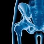 ¿Por cuánto tiempo debes tomar biofosfonatos para la osteoporosis?