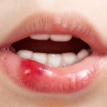<!--:ES-->¿Qué es la estomatitis? Tipos, causas y tratamientos de estas molestas lesiones en la boca<!--:-->