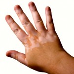 Una nueva esperanza para el tratamiento del vitiligo