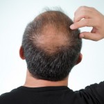 <!--:ES-->Hombres: ¿Hay relación entre la calvicie y la salud cardíaca?<!--:-->