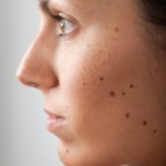 <!--:ES-->¿Manchas en la piel? Cuando el melasma o cloasma afecta tu cutis <!--:-->