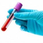 La prueba del APE para el cáncer de próstata ¿sí o no?