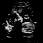 La quimioterapia no le haría daño al bebé 