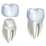 ¿Una corona dental en menos de una hora? Ya es posible