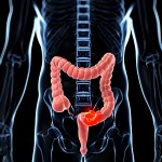 La detección temprana del cáncer colorrectal es un factor clave para tratar con éxito esta enfermedad La detección temprana del cáncer colorrectal es un factor clave para tratar con éxito esta enfermedad