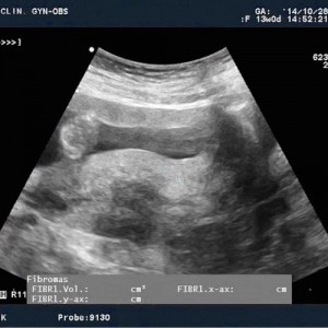 fibromas uterinos