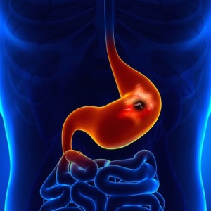 cáncer del estómago