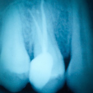 endodoncia