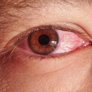 ardor en el ojo