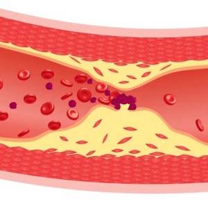 Athersclerosis in artery