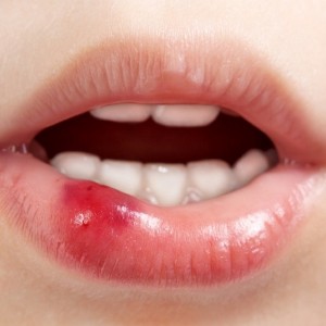 estomatitis