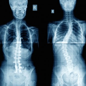 escoliosis