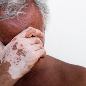 Desperate man affected by vitiligo