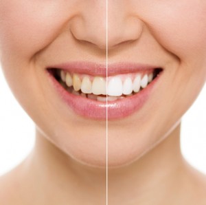 dientes manchados