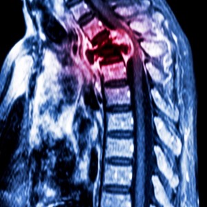cáncer en la espina dorsal