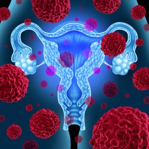 cáncer del ovario