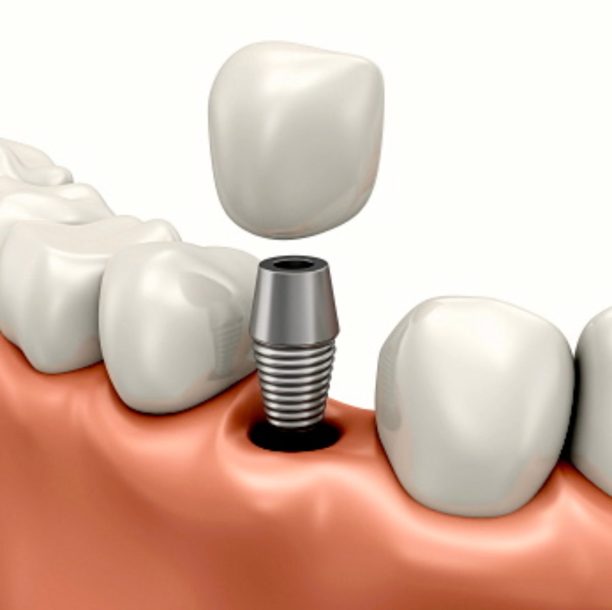 implantes dentales en republica dominicana gratis